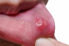 口腔有癌，舌頭先知？舌頭這種現象，很多人都錯認為是口腔潰瘍 
